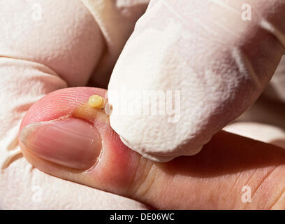 Bacterial infection, inflammation, index finger, abscess, remove pus, surgical gloves Stock Photo