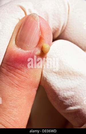 Bacterial infection, inflammation, index finger, abscess, remove pus, surgical gloves Stock Photo