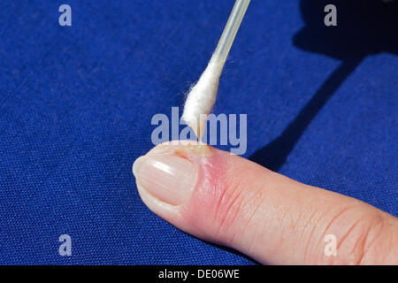 Bacterial infection, inflammation, index finger, pus, abscess, swab Stock Photo