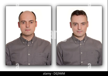 Bald man with a Wig. Before & After Concept. Stock Photo
