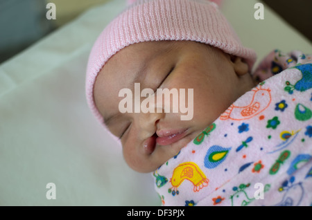 Newborn baby with cleft lip and palate sleeping. Stock Photo