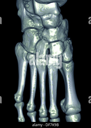 three-dimensional CT scan reconstruction showing a tripod fracture ...