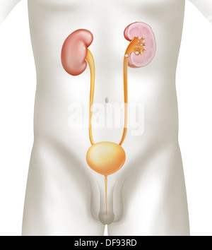 RENAL LITHIASIS DRAWING Stock Photo