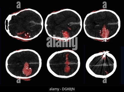 CT scan of the brain of a man who shot himself Stock Photo