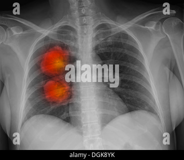 melanoma metastatic lungs alamy