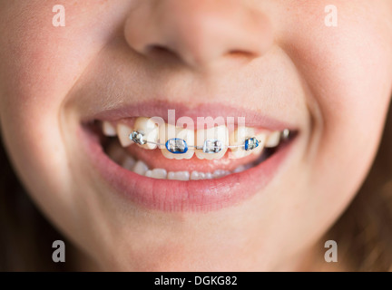 Close up of girl's (8-9) mouth with braces Stock Photo