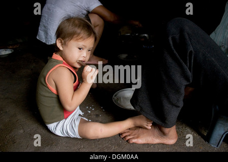Tawan, a 5-year-old boy living in poverty is afflicted with Down syndrome (DS) in Kampong Cham, Cambodia. Stock Photo
