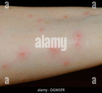 Wheals and nodules on a forearm after an allergic reaction to harvest mites (Neotrombicula autumnalis) Stock Photo