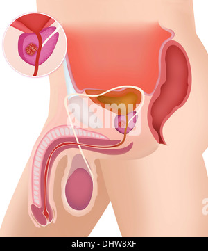 CANCER OF THE PROSTATE, DRAWING Stock Photo