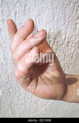 Scorched Flabby Skin on Fingers Stock Photo