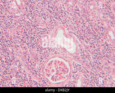 Histology micrograph  of renal failure, showing interstitial nephritis in tissue of kidney with H&E stain Stock Photo