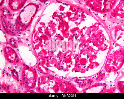 Histology micrograph  of renal failure, showing interstitial nephritis in tissue of kidney with H&E stain Stock Photo