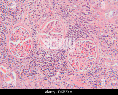 Histology micrograph  of renal failure, showing interstitial nephritis in tissue of kidney with H&E stain Stock Photo