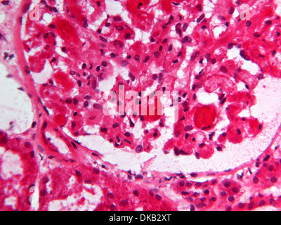 Histology micrograph  of renal failure, showing interstitial nephritis in tissue of kidney with H&E stain Stock Photo