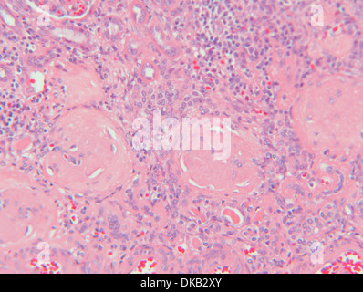 Histology micrograph  of renal failure, showing interstitial nephritis in tissue of kidney with H&E stain Stock Photo