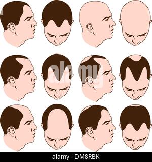 Receding Hairlines Stock Vector