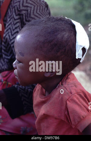 Apr 08, 1994 - Burundi, Rwanda - Young child with machete wound to the back of the head as Rwandan Tutsi refugees flee across the border into Burundi as the Hutus commited genocide in a 100 day civil war. The Rwandan Genocide was the 1994 mass murder of an estimated 800,000 people in the small East African nation of Rwanda. Over the course of approximately 100 days from the assassi Stock Photo