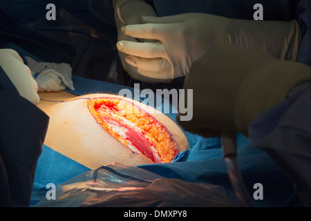 Surgeons perform a hysterectomy on a woman with endometrial cancer. Stock Photo