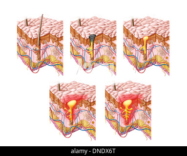 Different types of acne, non-inflammatory and inflammatory. Stock Photo