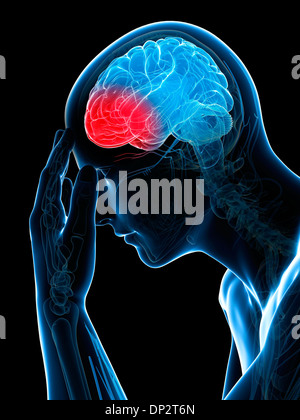 Headache, artwork Stock Photo