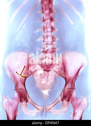 Ectopic IUD contraceptive, X-ray Stock Photo