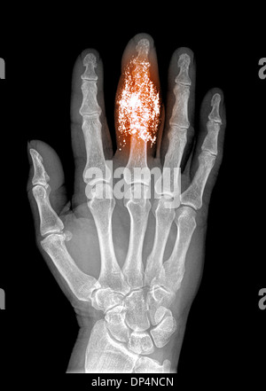 FOREIGN BODY, X-RAY Stock Photo - Alamy