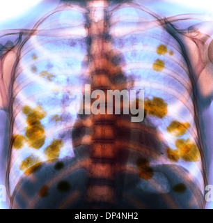 Secondary lung cancer, X-ray Stock Photo