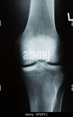 X-ray photograph or Roentgen image of a human knee with tibia, femur, fibula and patella Stock Photo