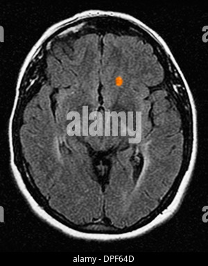 CT scan of brain showing multiple sclerosis Stock Photo