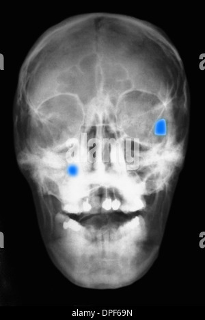 X-ray of skull showing two bullets Stock Photo