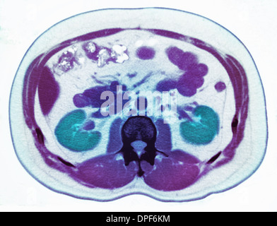 CT scan showing kidney stone Stock Photo