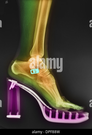 colorized x-ray of a foot in a high-heeled shoe Stock Photo