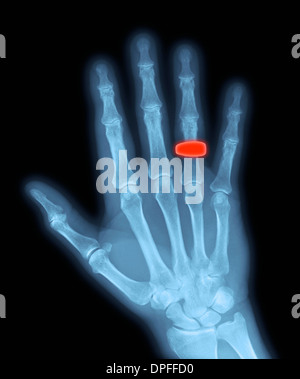 normal x-ray of the hand showing a wedding band Stock Photo