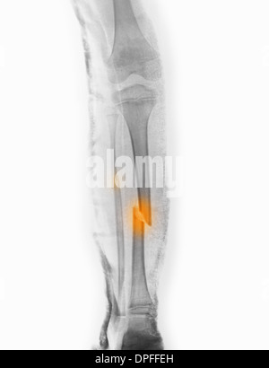 x-ray showing tibia and fibula fracture Stock Photo