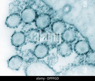 Transmission electron micrograph of AIDS, HIV-1