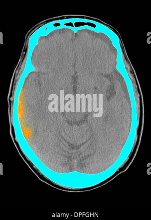 CT scan of head showing acute subdural hematoma Stock Photo