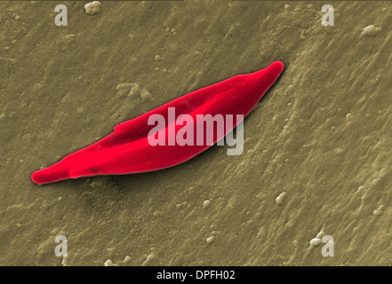 SEM of a sickle cell red blood cell Stock Photo