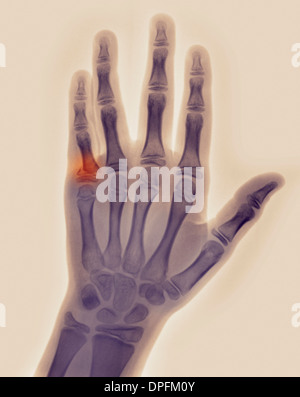 x-ray of hand with fracture of a proximal phalanx Stock Photo - Alamy