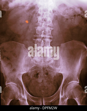 abdomen x-ray showing a stone in the kidney Stock Photo