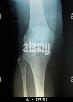 X-ray of Normal Knee Stock Photo: 134945693 - Alamy