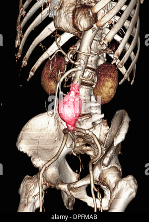 CT scan image showing an abdominal aortic aneurysm Stock Photo ...