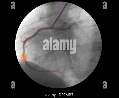 angiogram of RCA showing stenosis and repair Stock Photo