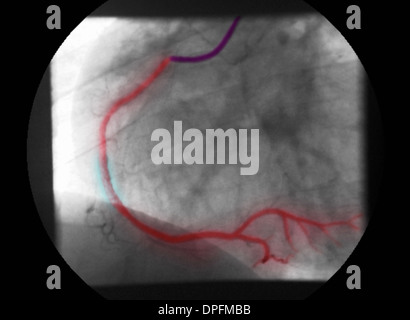 angiogram of RCA showing stenosis and repair Stock Photo