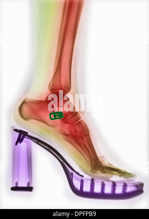 colorized x-ray of foot in a high-heeled shoe Stock Photo