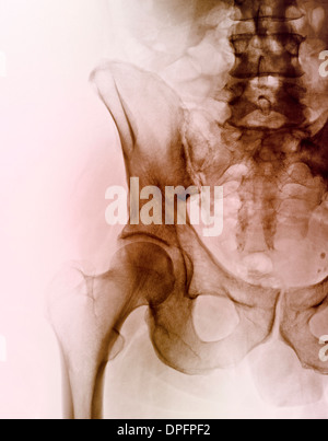 Hip skeleton hi-res stock photography and images - Alamy