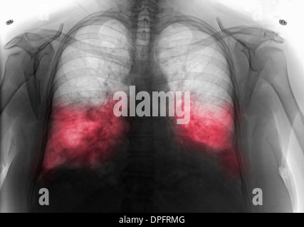 Color enhanced chest x-ray showing asbestosis, a kind of pneumoconiosis ...