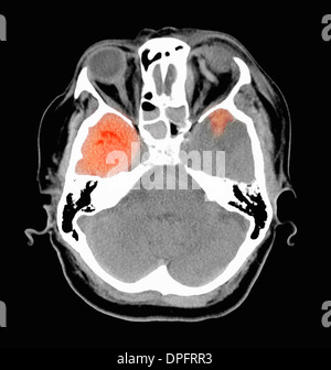 CT scan of head showing acute subdural hematoma Stock Photo