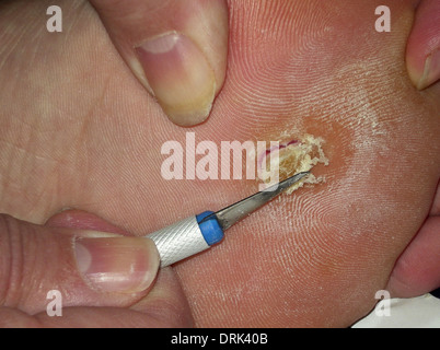 A large verucca, or plantar wart, is removed by scalpel in the underside of a man's foot Stock Photo