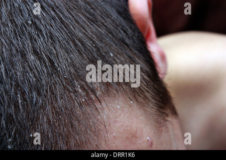 Dandruff in the hair. Symptoms of skin disease Stock Photo - Alamy