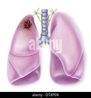 LUNG CANCER, DRAWING Stock Photo